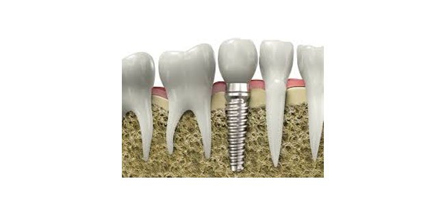 Dental Implants - Jehovah Dental Centre