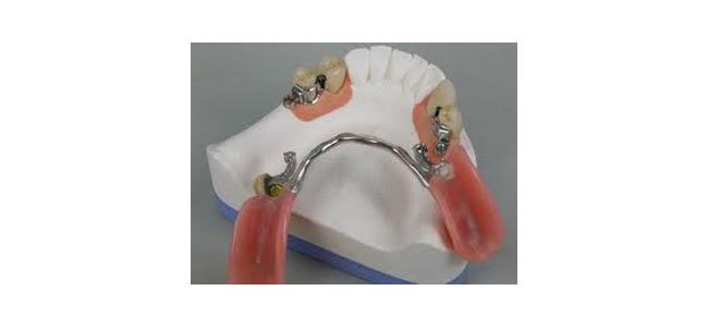 Precision Attachment - Jehovah Dental Centre