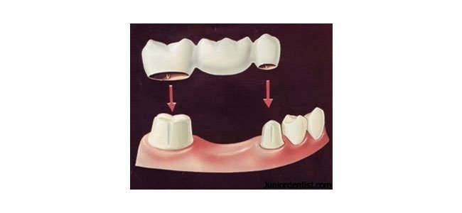 Fixed Partial Dentures - Jehovah Dental Centre