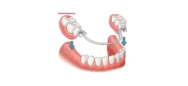 Partial Dentures - Jehovah Dental Centre